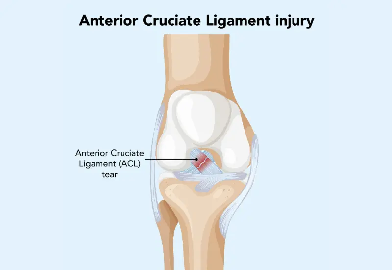 acl surgery