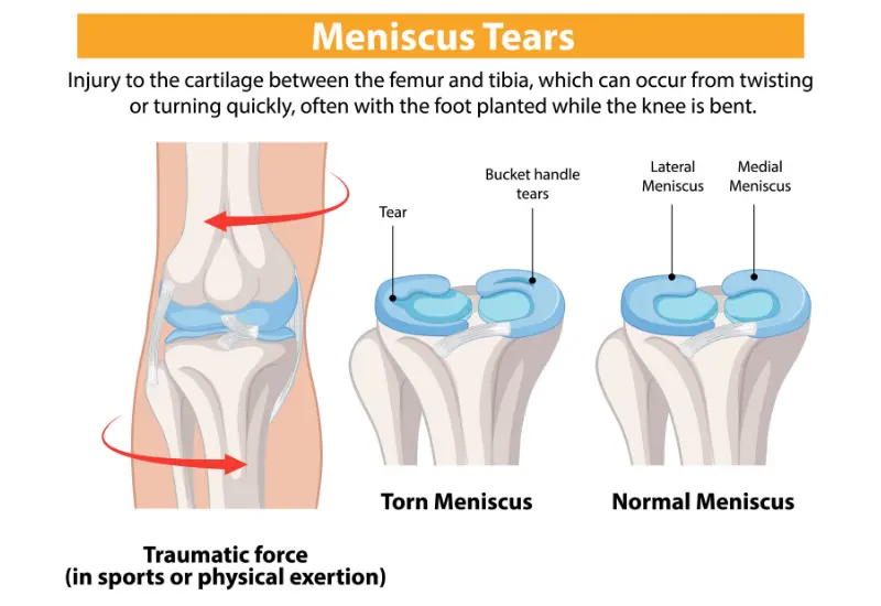 meniscus repair surgery